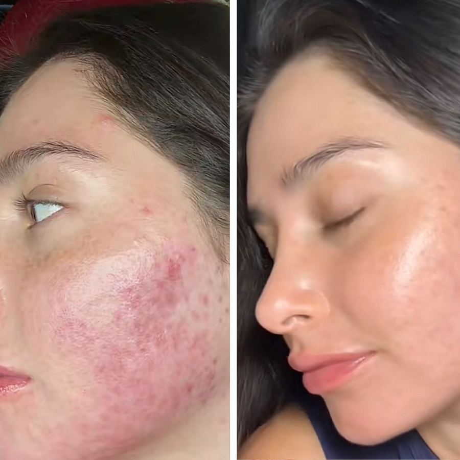 Pleť před a po používání LED masky na obličej LumenLuxe – Natália S.