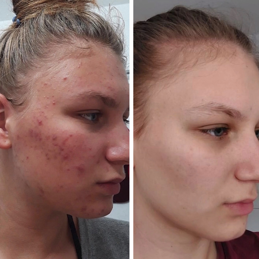Pleť před a po používání LED masky na obličej LumenLuxe – Monika